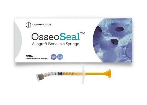 OsseoSeal Allograft Cortical/Cancellous (50/50) Powder, 250-1000um:2.5cc, 5cc