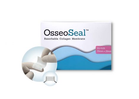 OsseoSeal Prefilled Allograft in Syringe